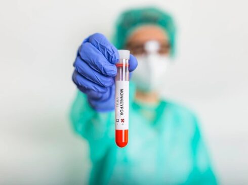 Profissional da saúde segura nas mãos um frasco de exame de sangue e o resultado positivo para varíola do macaco.